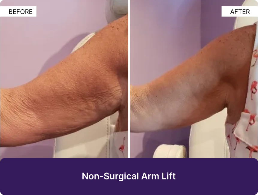 Before and after comparison of arm showing improved skin tightness and reduced sagging following non-surgical arm lift treatment