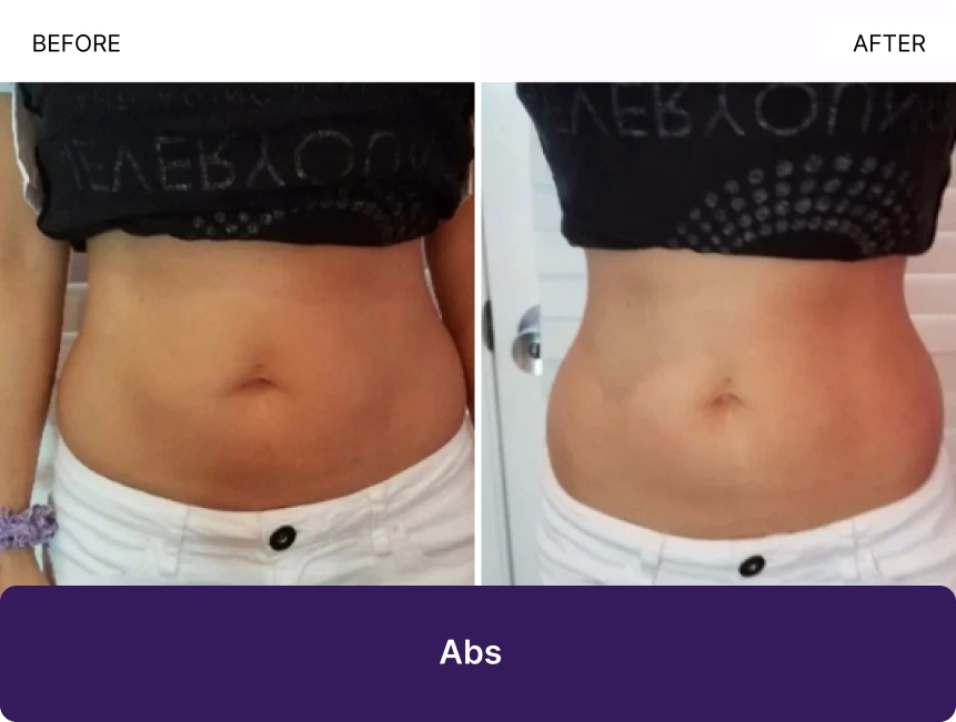 Before and after abdominal sculpting results showing reduced midsection softness and improved definition