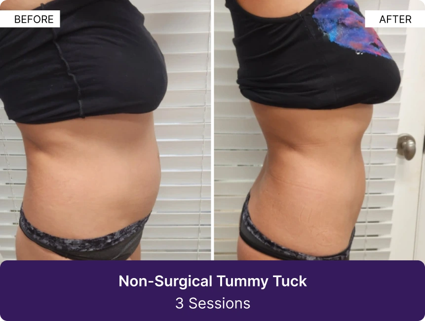 Before and after comparison of non-surgical tummy tuck results after 3 sessions, showing reduced abdominal fullness