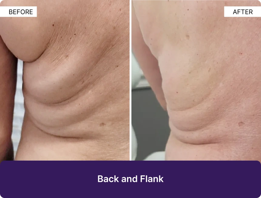 Before and after back and flank sculpting results showing reduced skin laxity and improved definition