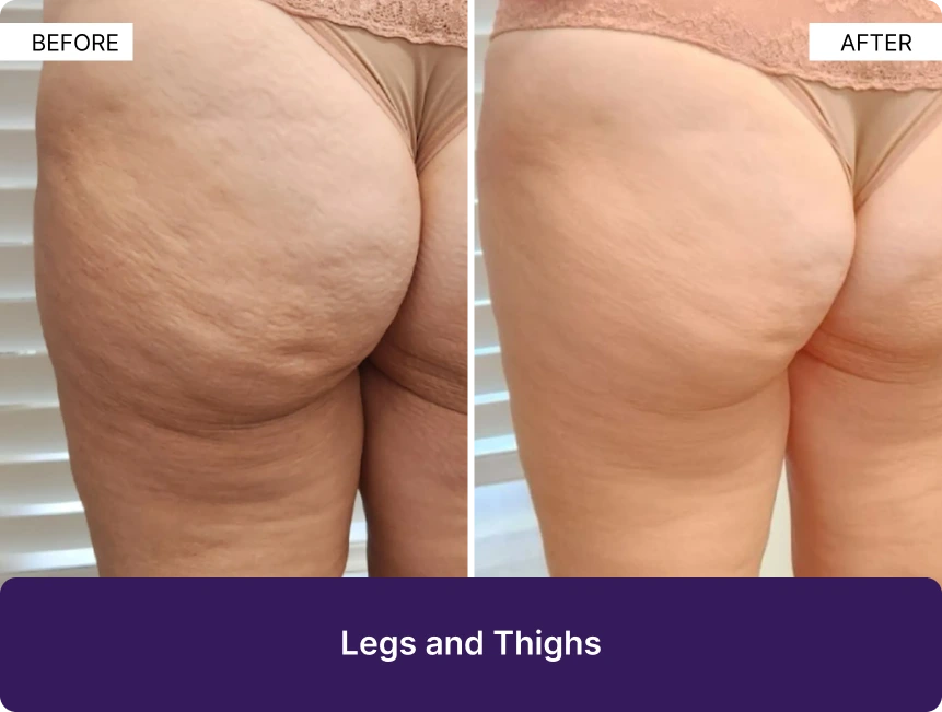 Before and after comparison of legs and thighs showing reduced cellulance and smoother skin texture