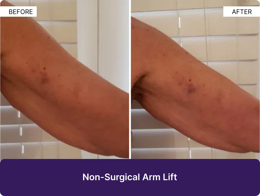Before and after comparison of arm showing improved skin texture and firmness from non-surgical arm lift treatment