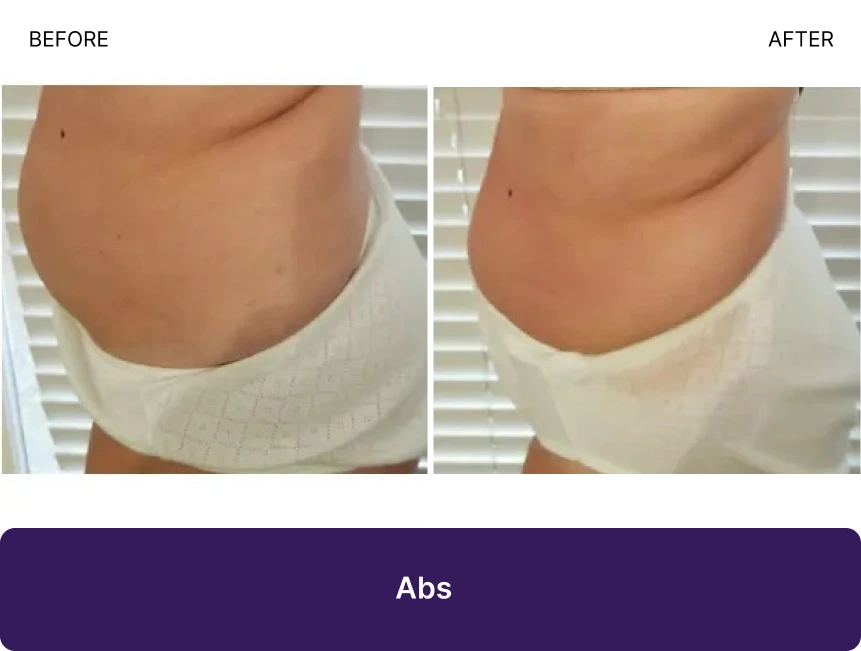 Before and after abdominal sculpting showing reduced midsection fullness and improved contour