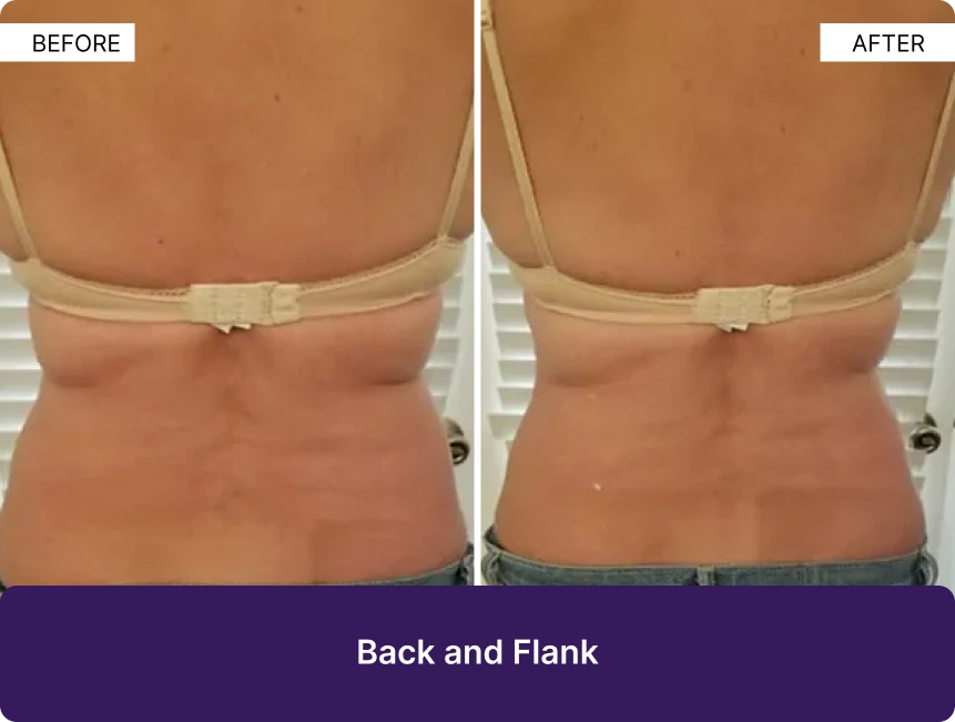 Back and flank before and after treatment showing reduced skin laxity and improved contour
