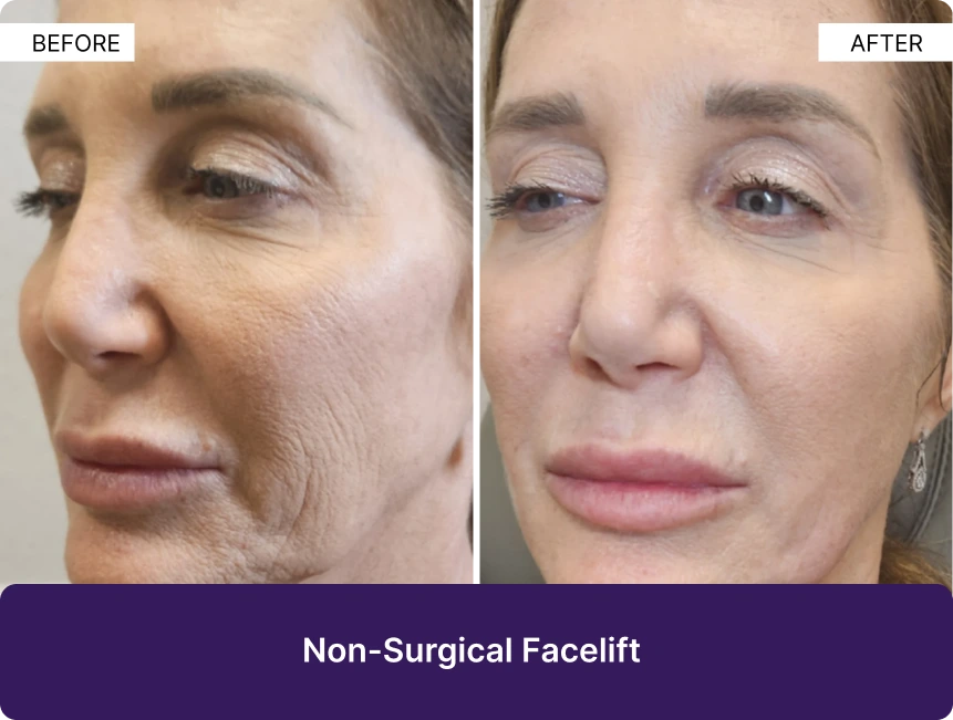 Before and after comparison of non-surgical facelift results showing reduced wrinkles and improved skin texture