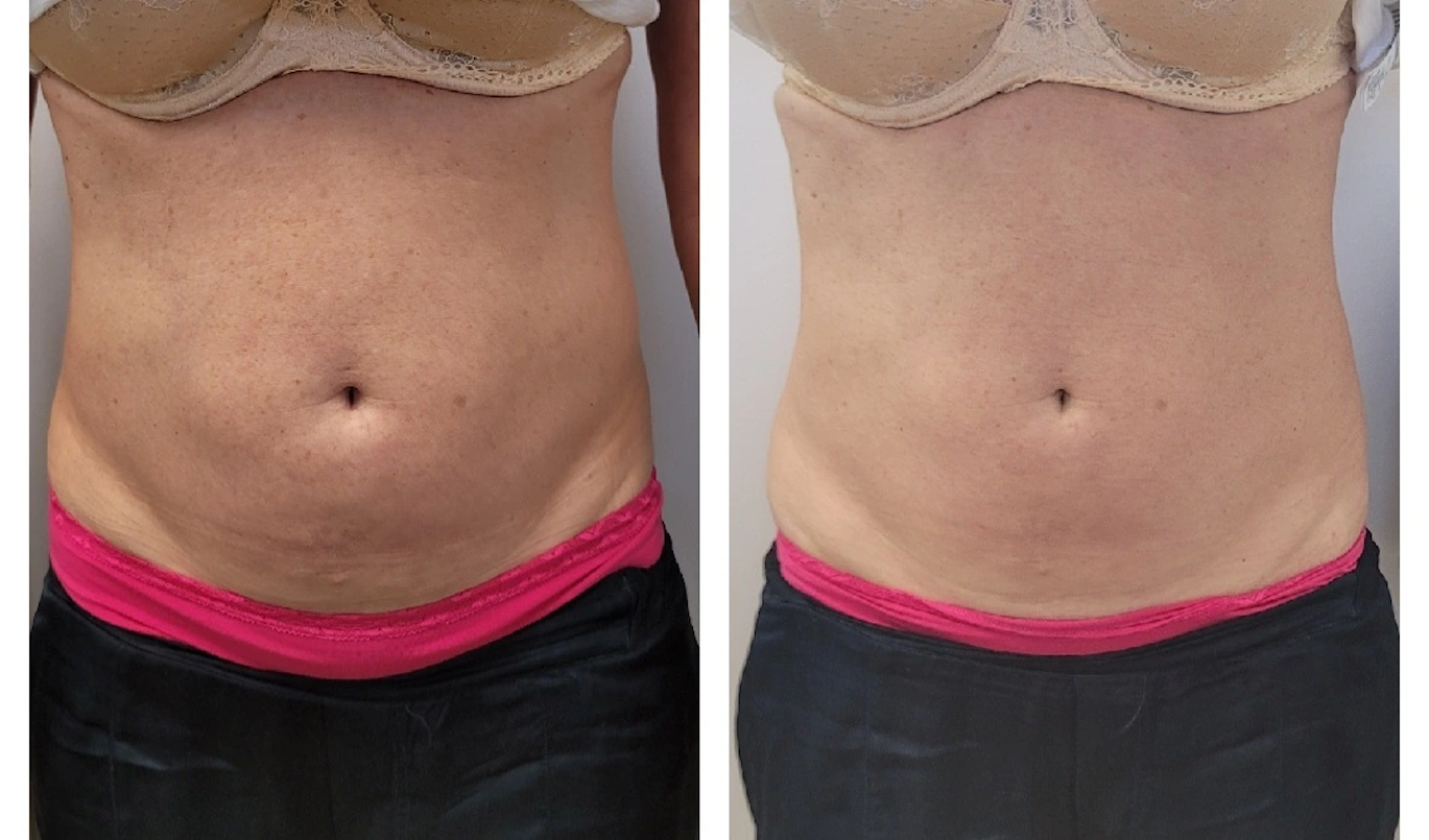 Emsculpt #U2013 Case 3
