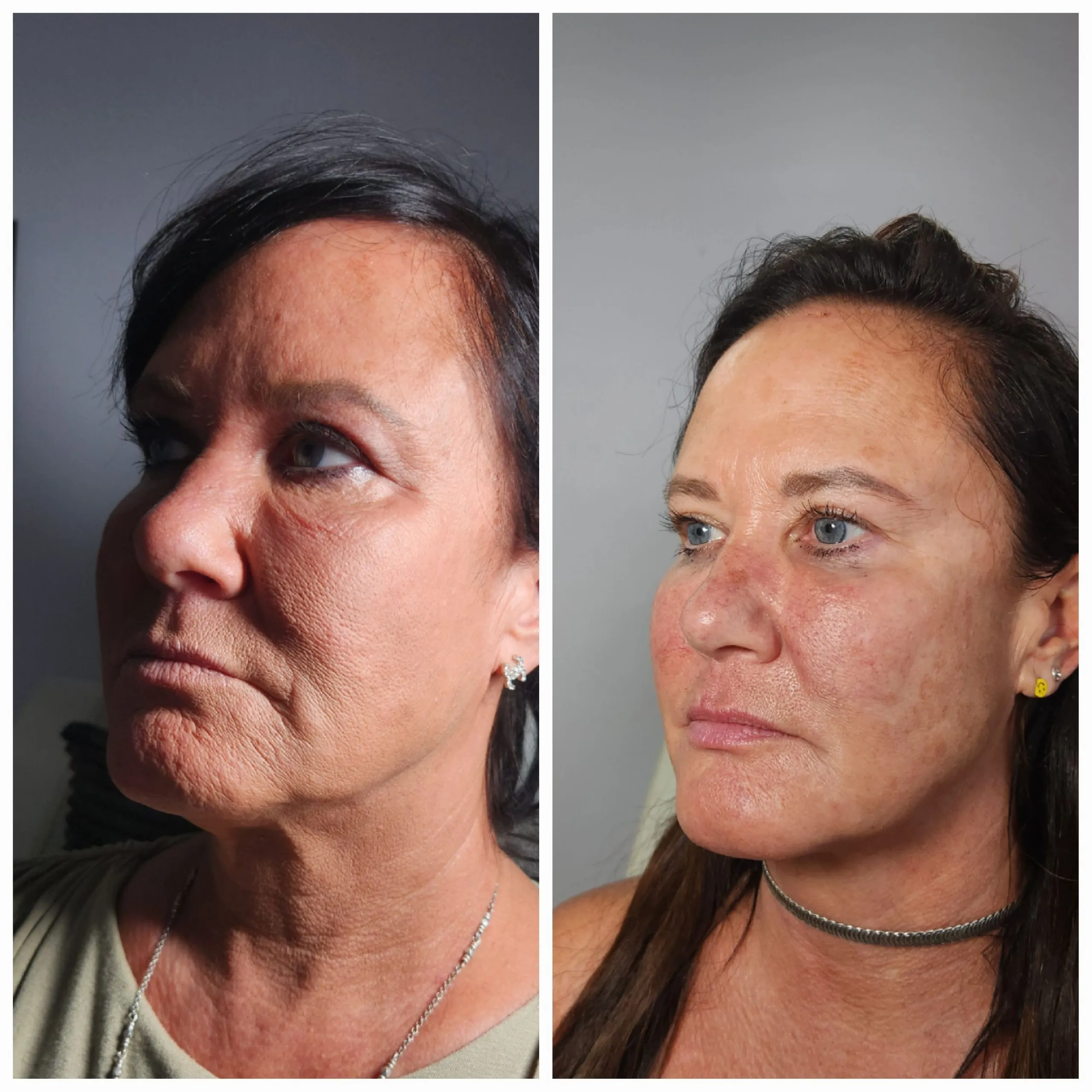 Face-and-neck-10