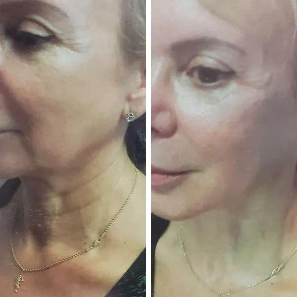 Face-and-neck-11.1