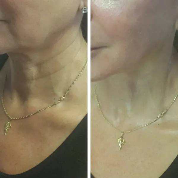 Face-and-neck-11.2