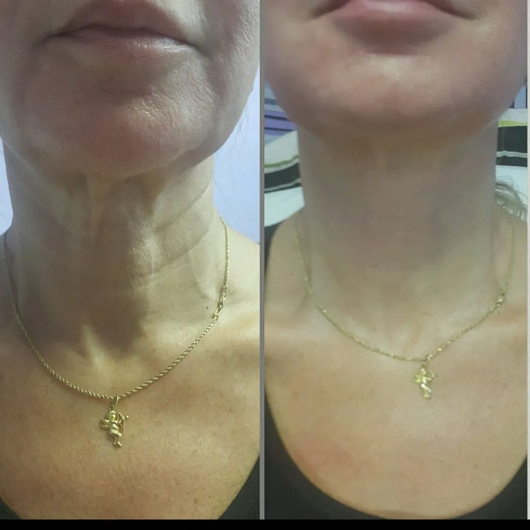 Face-and-neck-11