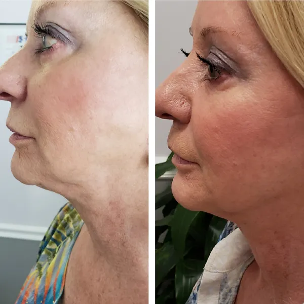 Face-and-neck-12.1