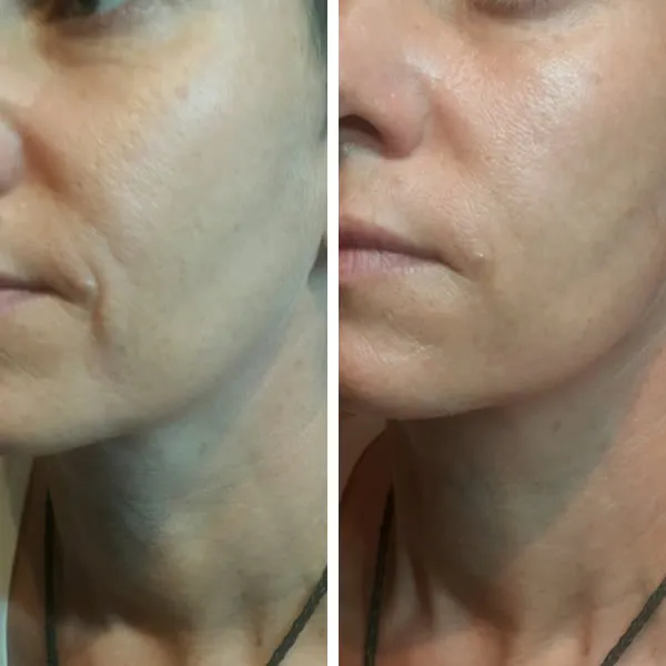 Face-and-neck-16