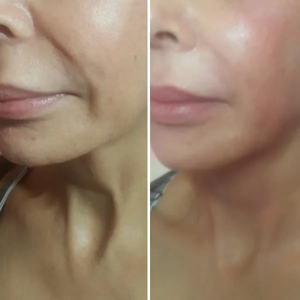 Face-and-neck-17