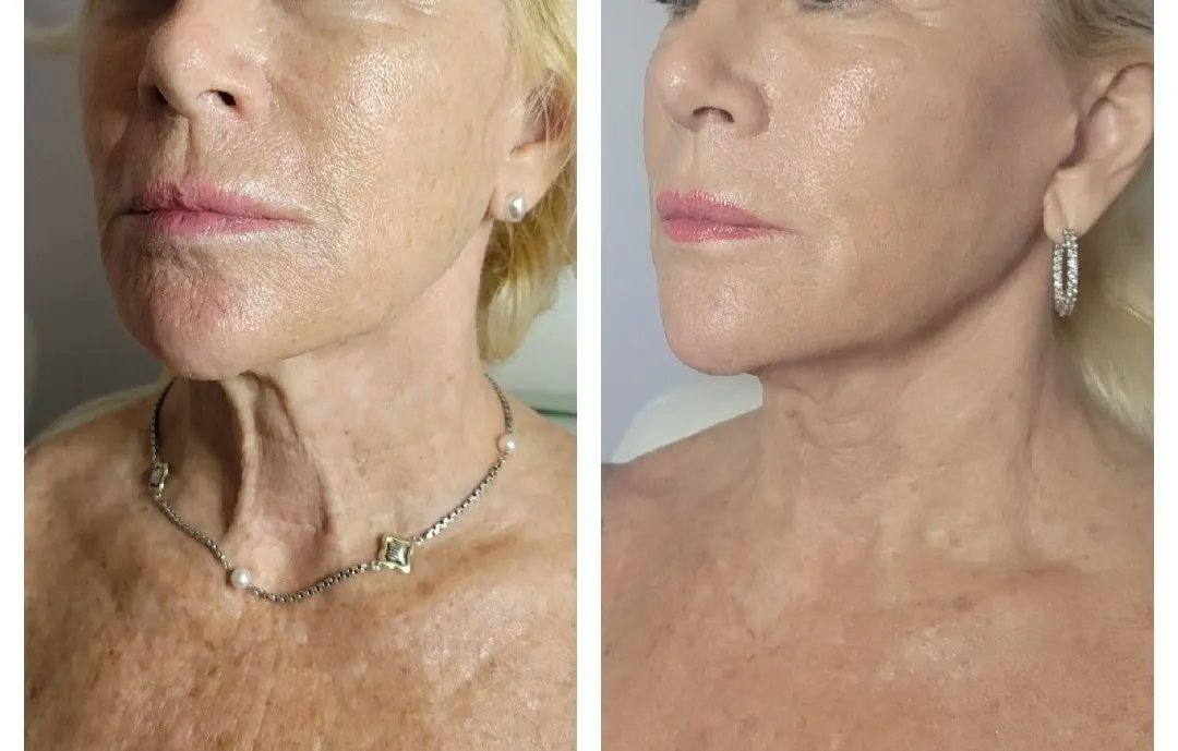 Face-and-neck-2