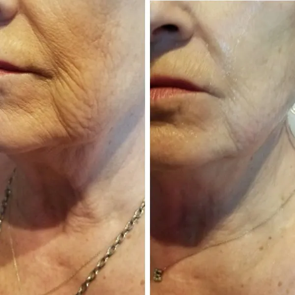 Face-and-neck-20