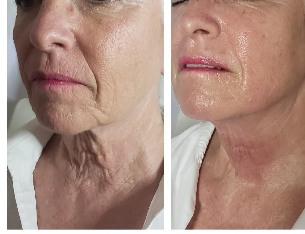 Face-and-neck-26