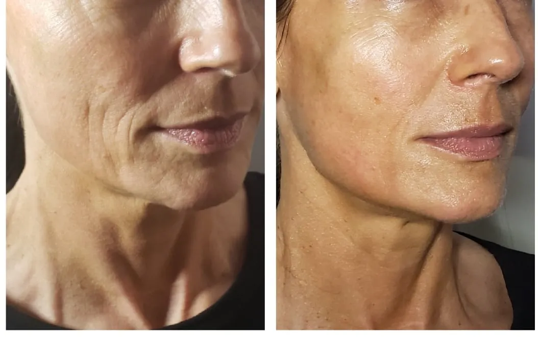 Face-and-neck-3