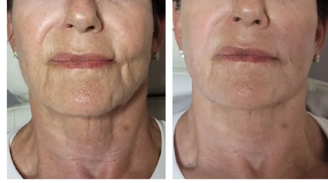 Face-and-neck-4
