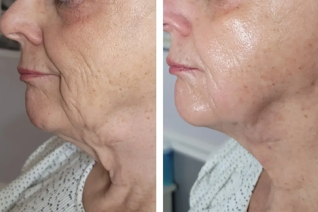 Face-and-neck-5