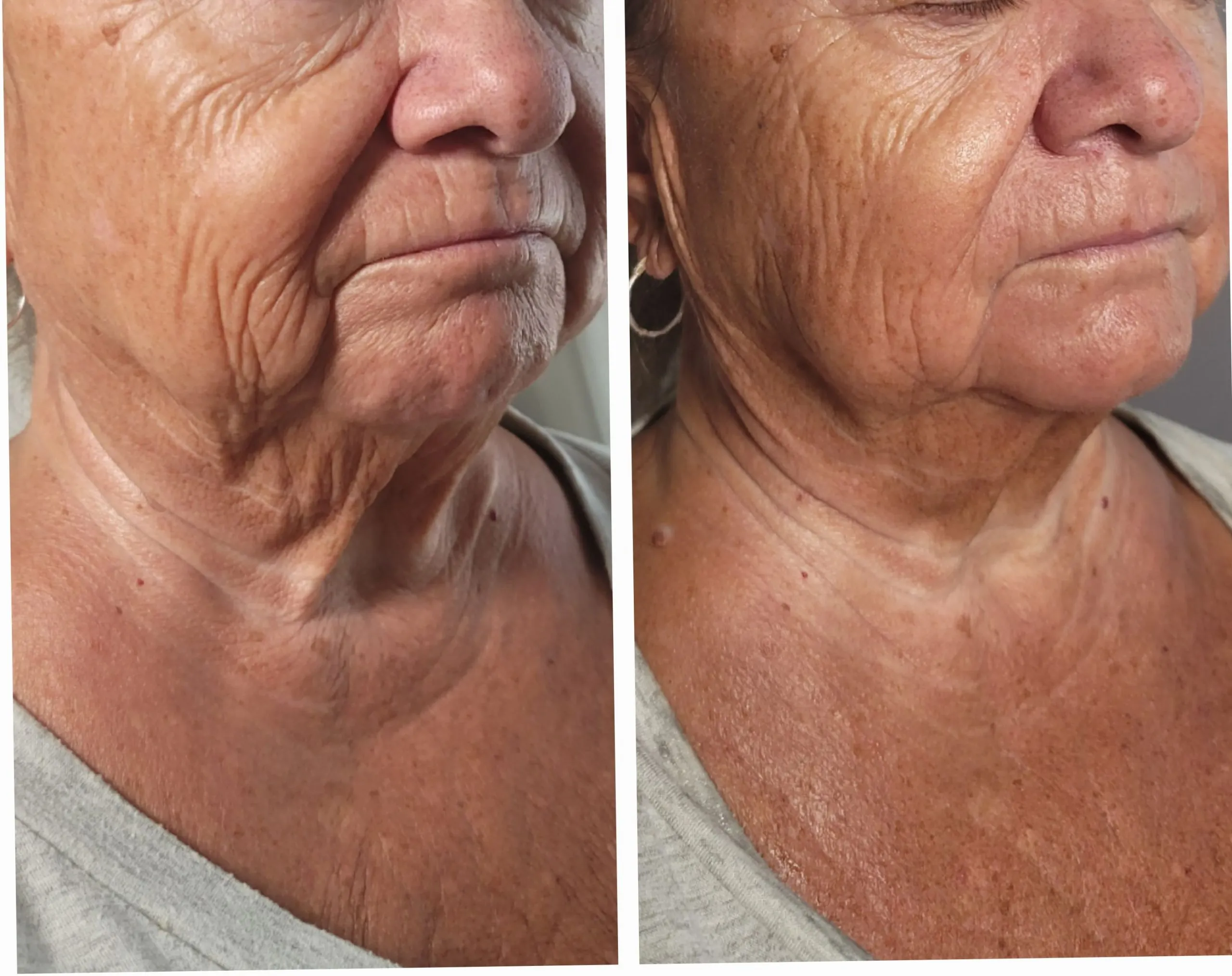 Face-and-neck-6