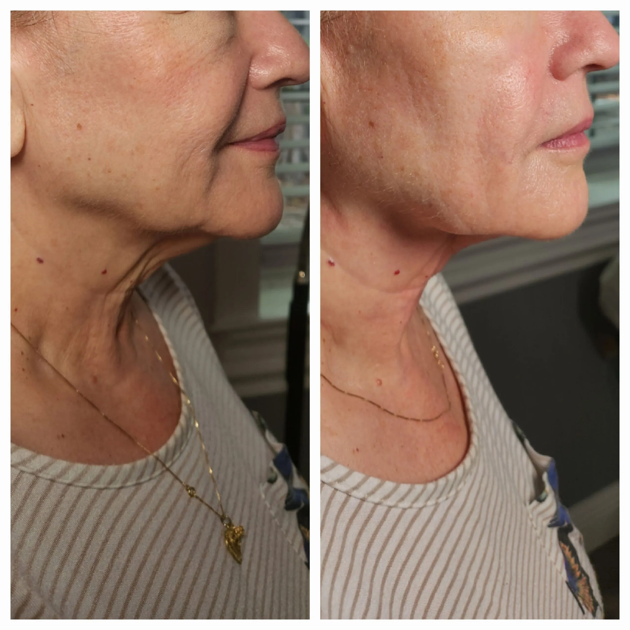 Face-and-neck-7