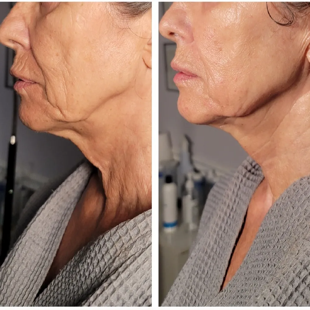 Face-and-neck-8