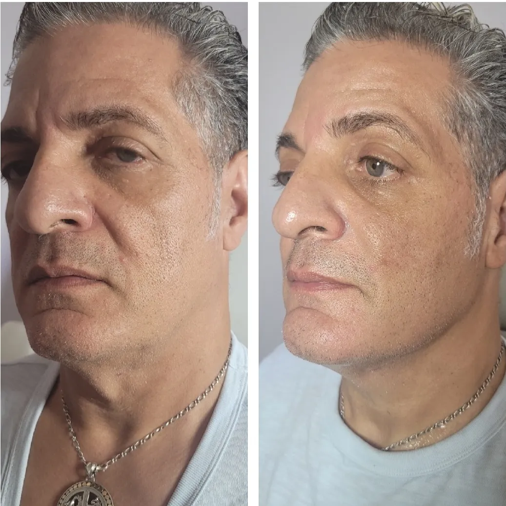 Face-and-neck-9