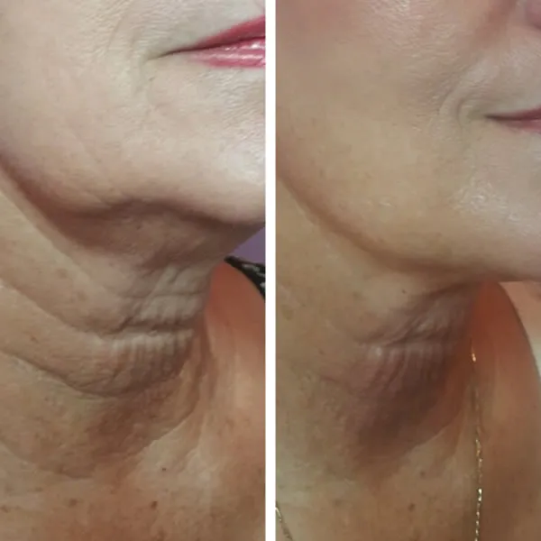Face and Neck #U2013 Case 18
