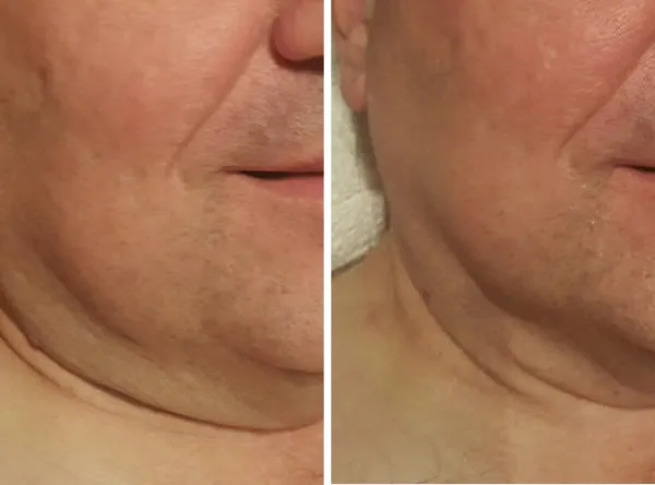 Face and Neck #U2013 Case 24