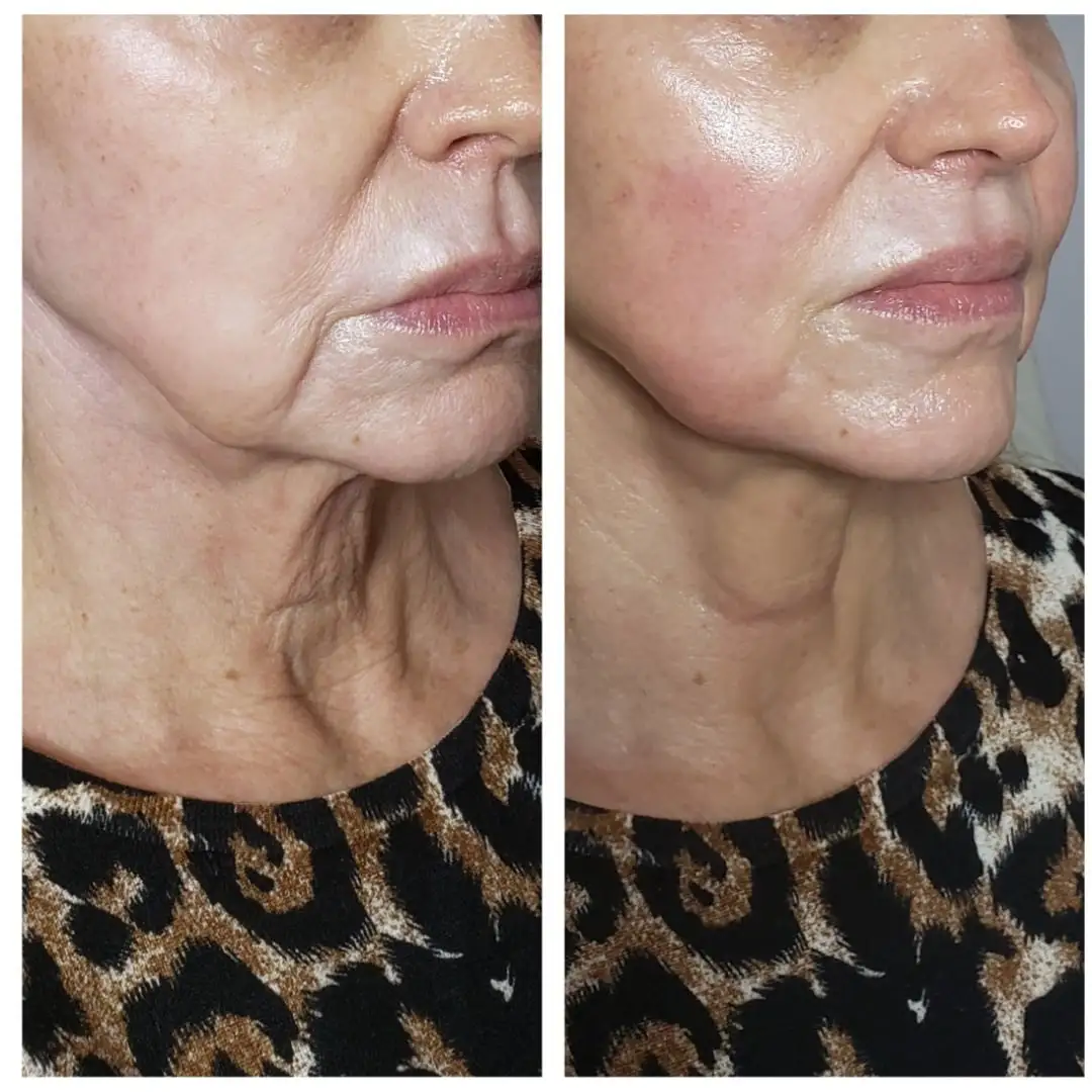 Face And Neck #U2013 Case 29-2