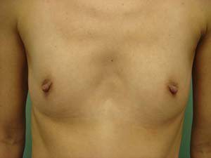 Breast Augmentation Before & After case 10