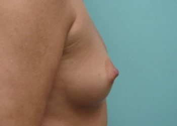 Breast Augmentation Before & After case 13