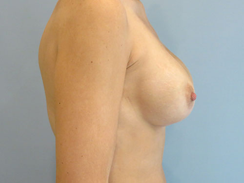 Breast Augmentation Before & After case 14