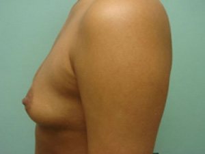 Breast Augmentation Before & After case 16