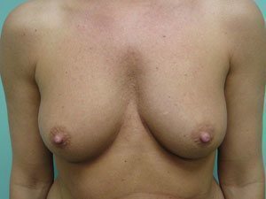 Breast Augmentation Before & After case 3