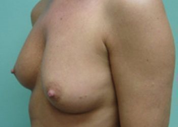 Breast Augmentation Before & After case 3