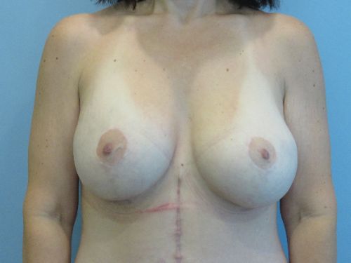 Breast Augmentation Before & After case 5