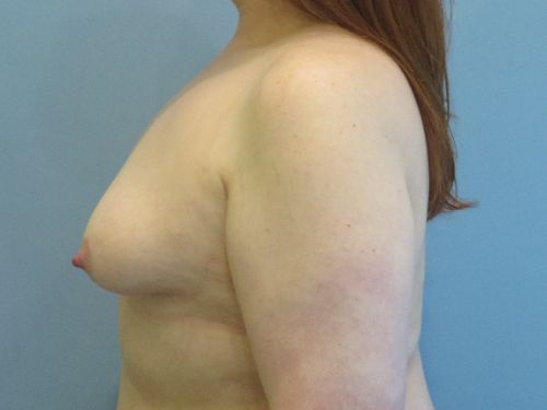 Breast Augmentation Before & After case 9