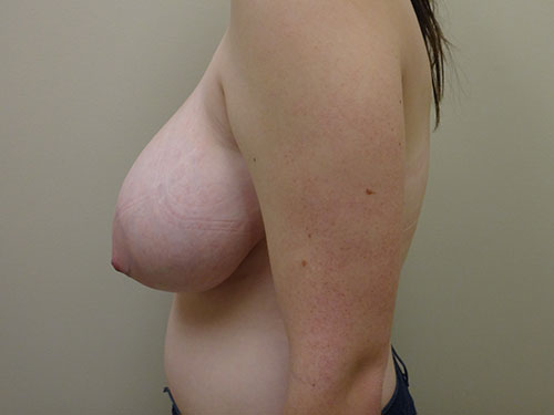 Breast Reduction Before & After case 2