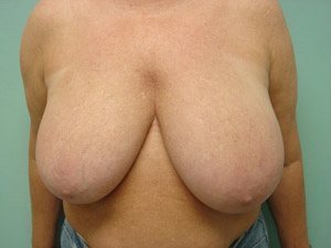 Breast Reduction Before & After case 4