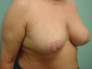 Breast Reduction Before & After