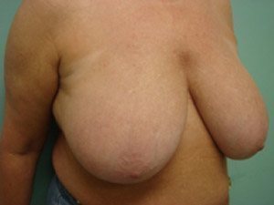 Breast Reduction Before & After case 4