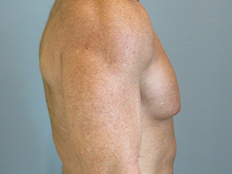 Gynecomastia Before & After case 10
