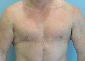 Gynecomastia Before & After case 2