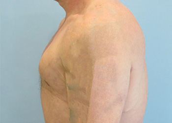 Gynecomastia Before & After case 2