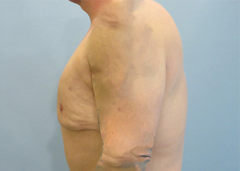 Gynecomastia Before & After case 2