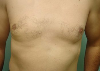 Gynecomastia Before & After case 3