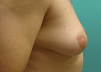 Gynecomastia Before & After case 3