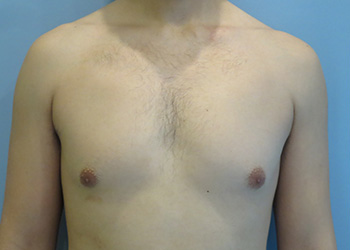 Gynecomastia Before & After case 4