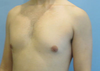 Gynecomastia Before & After case 4